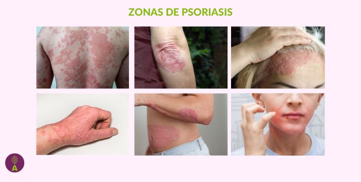 Psoriasis afecta a todas las zonas del cuerpo
Descubre en este artículo cómo recuperar una piel sana
